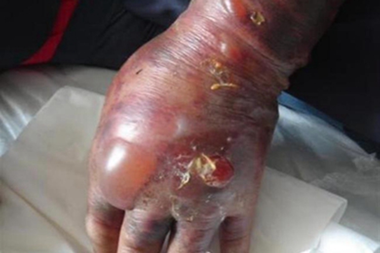 炭疽败血症大水疱图