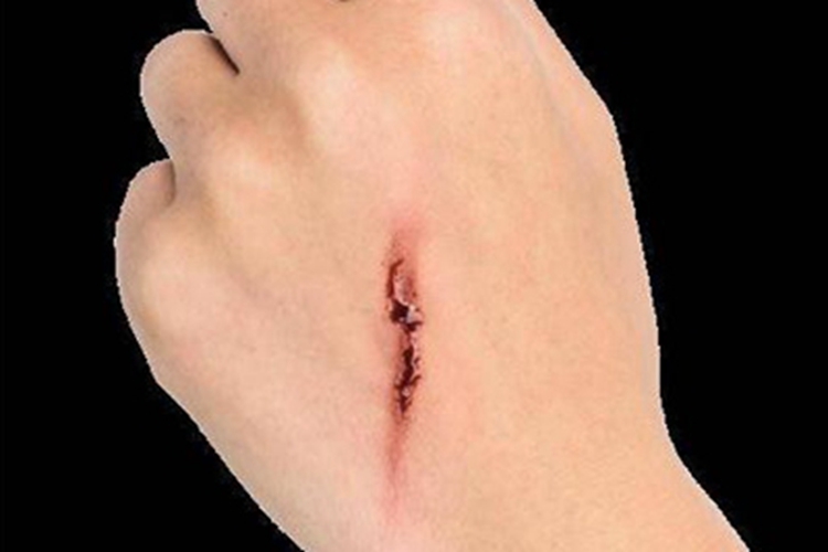 手背割伤有裂口图
