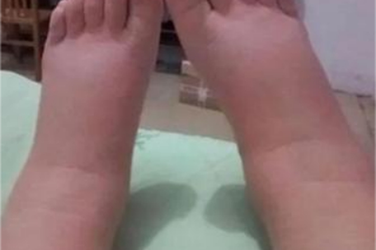 特发性水肿脚面增厚图