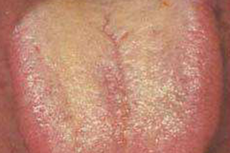 浅黄苔图 浅黄苔图