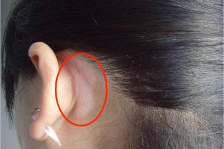 白癜风耳后症状图 白癜风耳后症状图