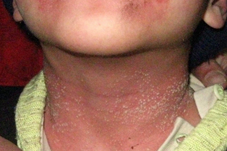 柯萨奇湿疹颈部症状图