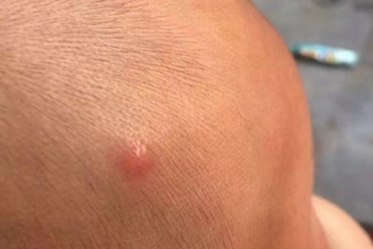 蚊虫叮咬小红疙瘩图