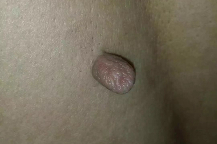 软纤维瘤背部症状图