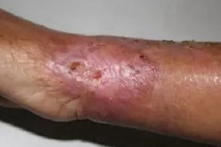 海鱼分枝杆菌感染胳膊脓肿图