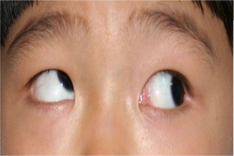 获得性上斜肌麻痹向左注视图