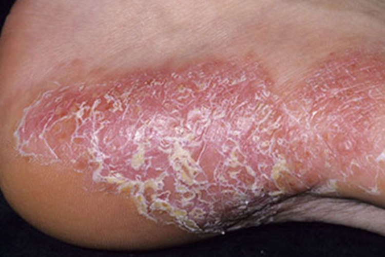 松皮癣脚底红斑图