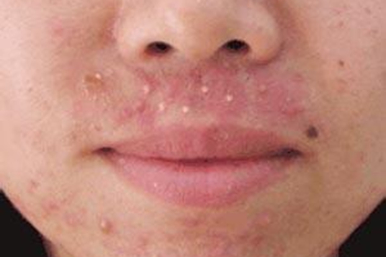 痤疮鼻子下面发红图