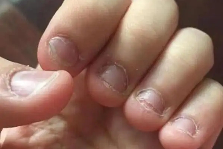 甲营养不良指甲缝里起白色硬皮图 甲营养不良指甲缝里起白色硬皮图