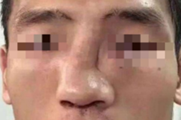 鼻中隔血肿鼻梁变弯图 鼻中隔血肿鼻梁变弯图