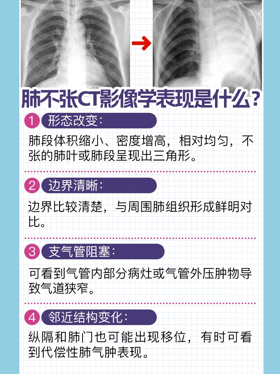 认真了解：肺不张CT影像学表现