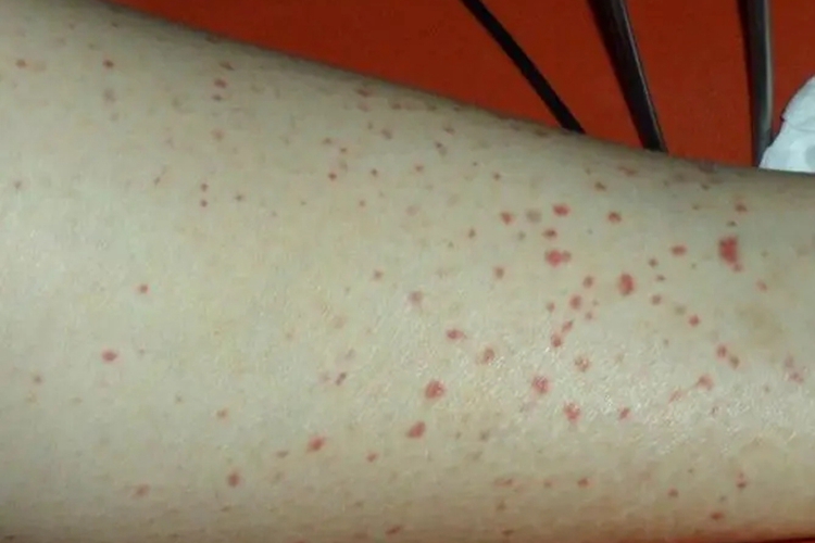 慢性苯中毒皮肤出血性红点图