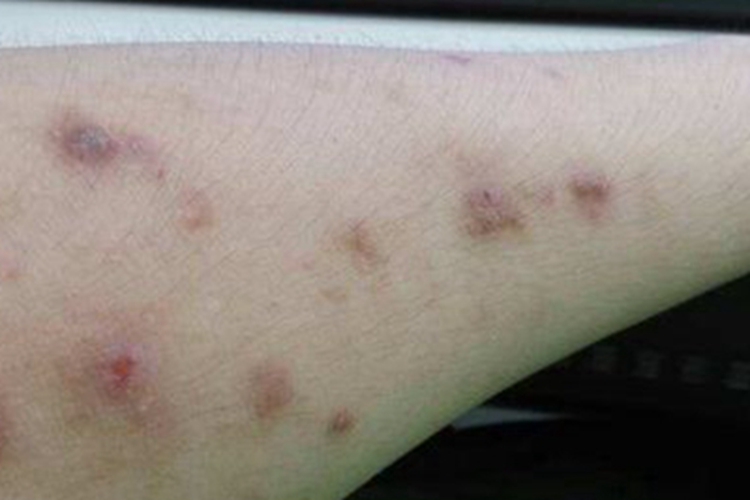 皮肤白血病胳膊丘疹图 皮肤白血病胳膊丘疹图