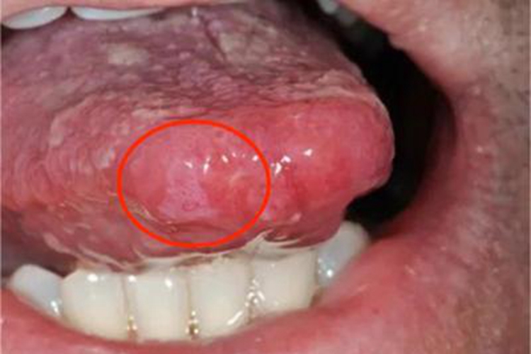 二期口腔梅毒舌尖症状图