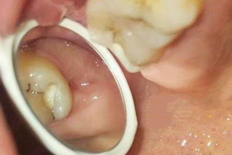 拔完牙90天后恢复图