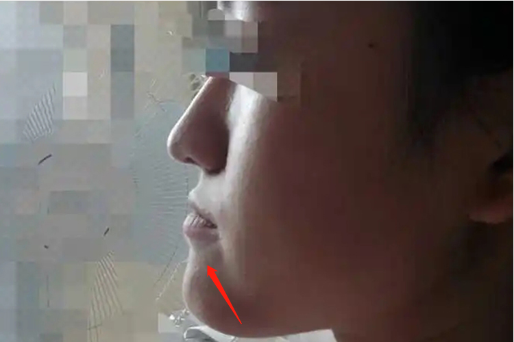 下颌前突导致严重嘴凸图 下颌前突导致严重嘴凸图