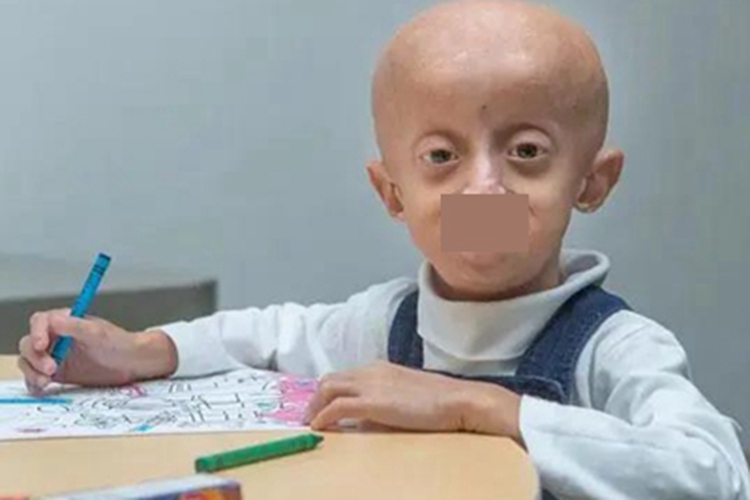 儿童早老症头部发育不良图