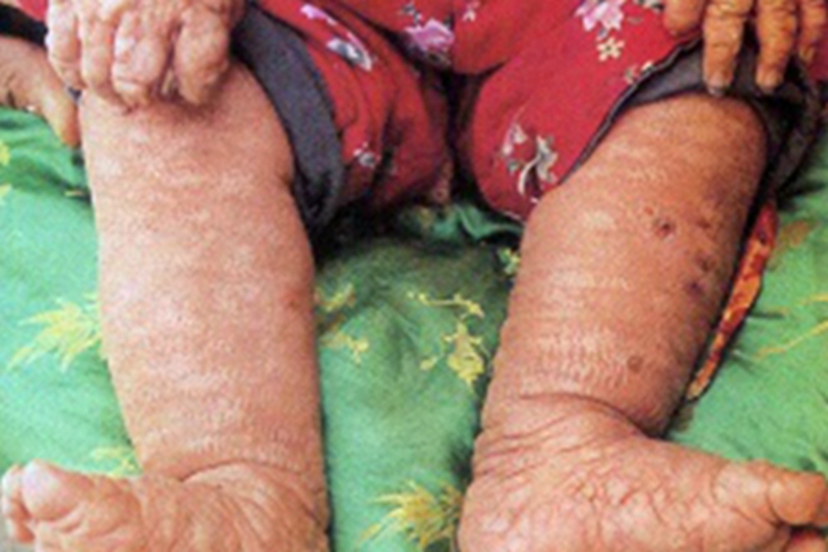 皮肤肥大细胞增生病腿皮肤粗糙图