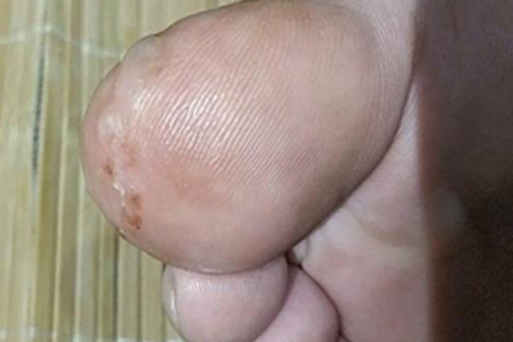 脚趾长水疱干瘪结痂图