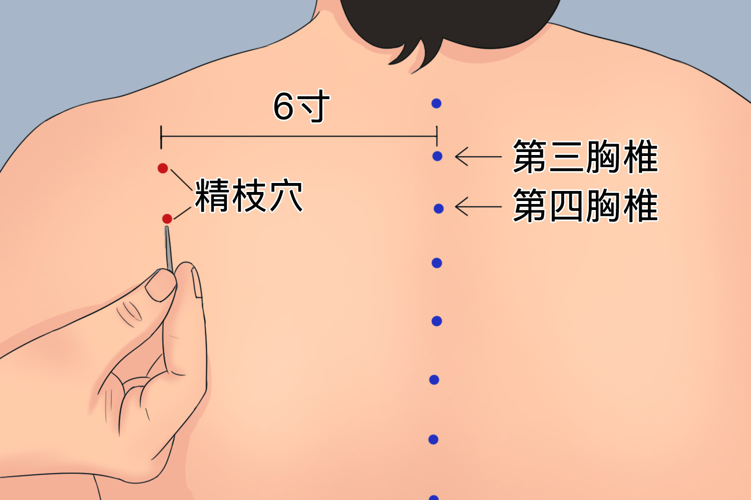 精枝点刺放血位置图 精枝点刺放血位置图