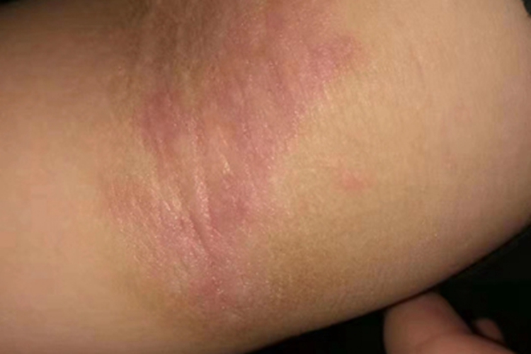 青年成人期特应性皮炎肘窝红斑图