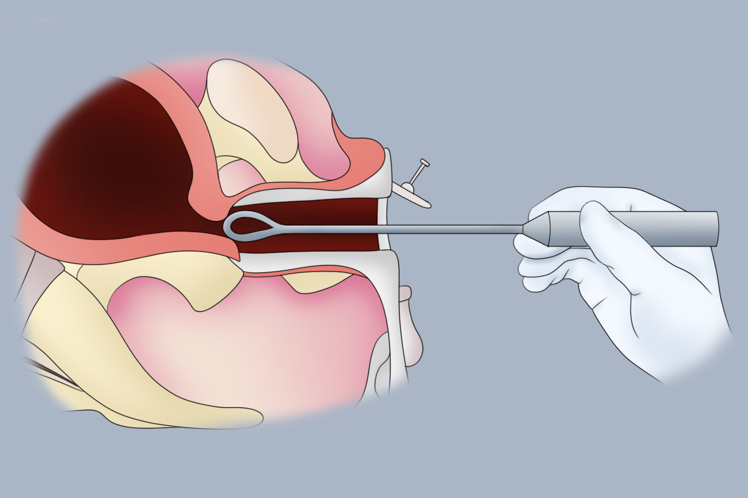 宫颈糜烂激光治疗图 宫颈糜烂激光治疗图