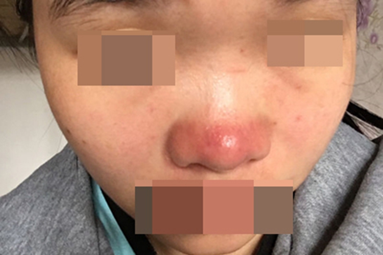 红斑毛细血管扩张型酒糟鼻红肿图