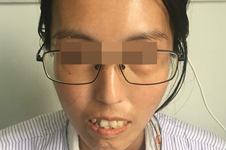 系统性硬皮病面部僵硬图 系统性硬皮病面部僵硬图