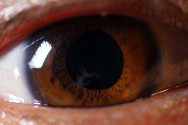 感染性休克瞳孔散大图 感染性休克瞳孔散大图