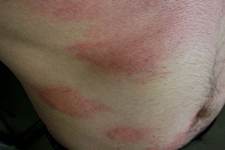 风疹风团图 风疹风团图