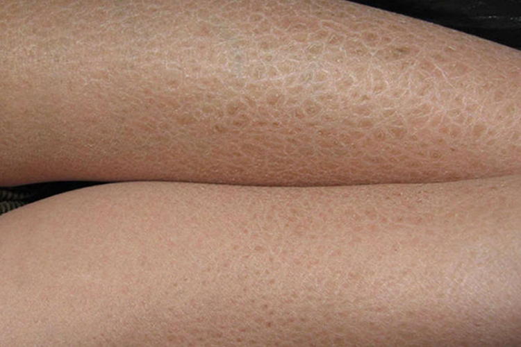 寻常型鱼鳞病图