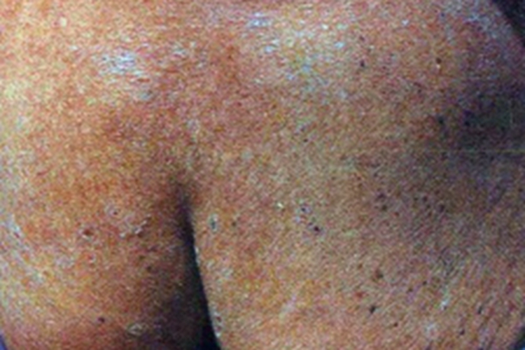 鳞状毛囊角化病臀部症状图 鳞状毛囊角化病臀部症状图