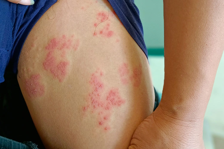 四肢轻度带状疱疹图