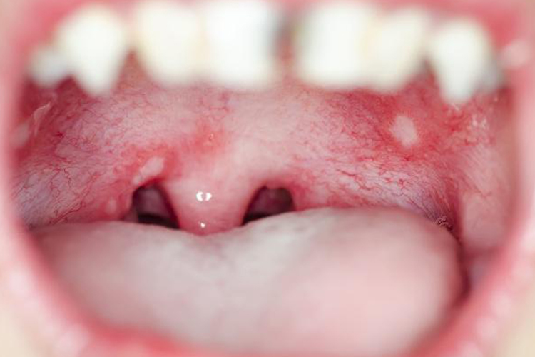 溃疡性口腔炎口腔后壁发炎图