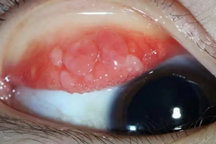 春季角结膜炎疙瘩图 春季角结膜炎疙瘩图