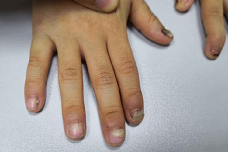 脱甲病指甲有不同程度分离图