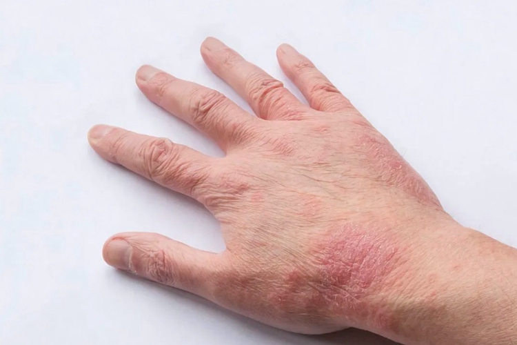 急性湿疹手背红斑图