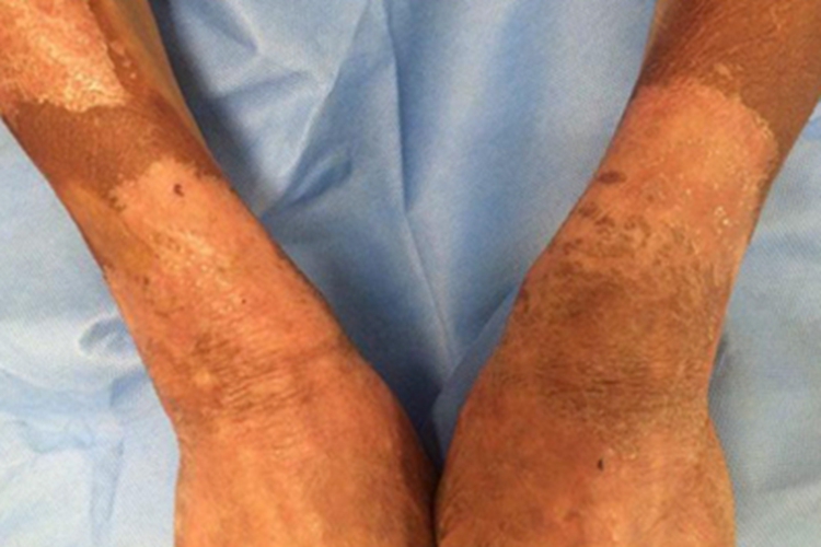 糙皮病胳膊脱屑图 糙皮病胳膊脱屑图