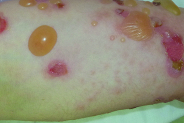 疱疹样天疱疮胳膊大水疱图