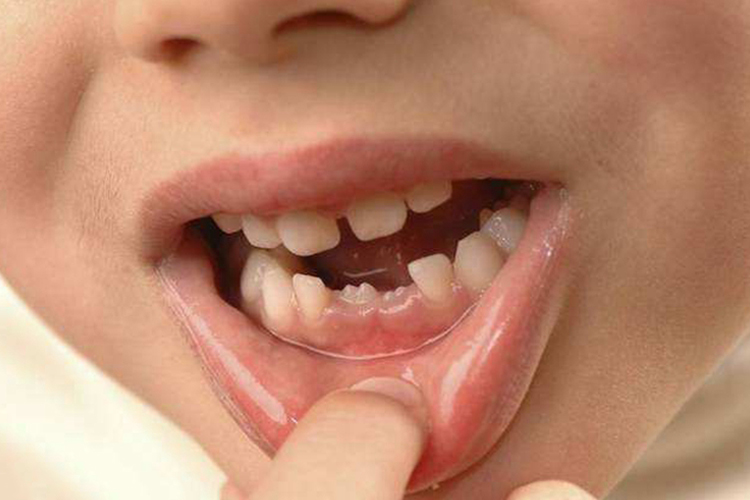 儿童牙齿萌出延迟图