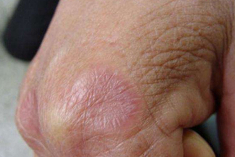 皮下型环状肉芽肿手背症状图