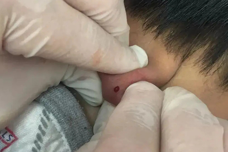 麦粒肿大椎穴放血图