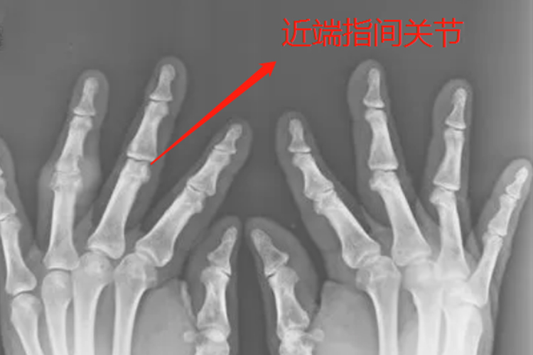 近端指间关节示意图