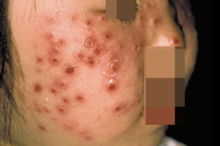 种痘样水疱病脸上有凹陷疹子图