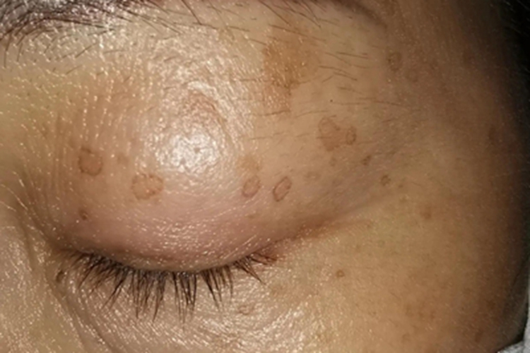 汗孔角化症症状图 汗孔角化症症状图