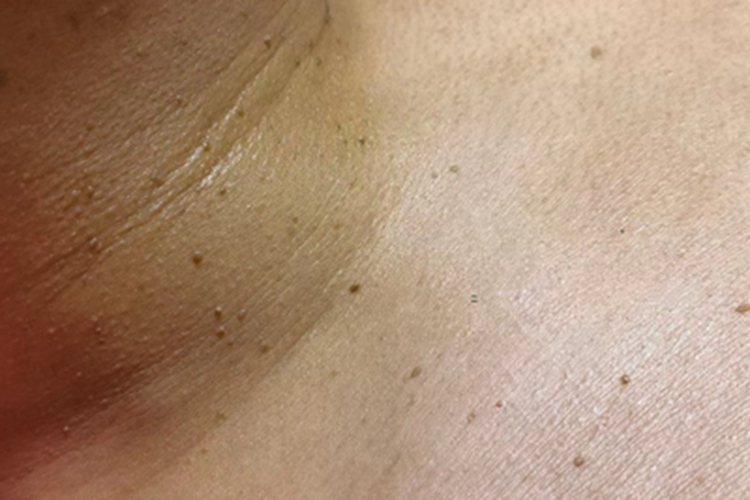 多发性皱纹状小丘疹颈部症状图