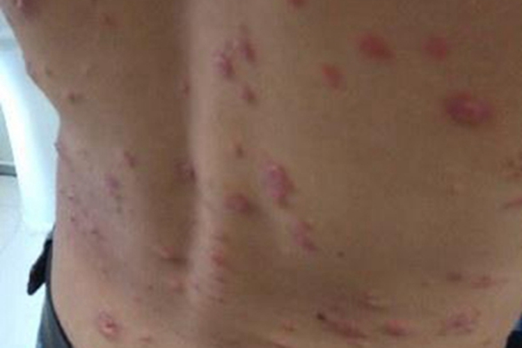 男性结节性梅毒疹背部疙瘩图 男性结节性梅毒疹背部疙瘩图