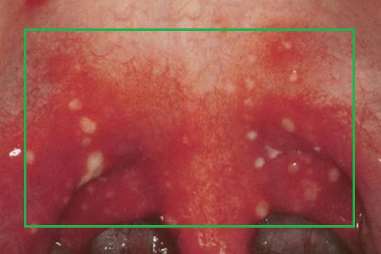 疱疹性咽炎水疱图