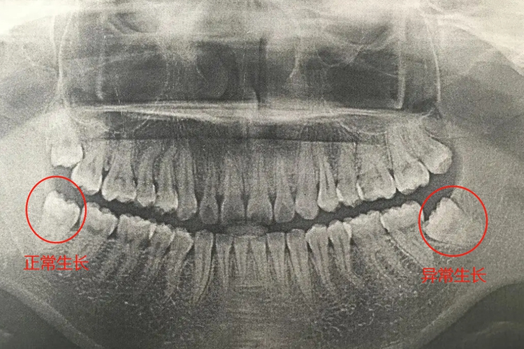 智齿生长对比图