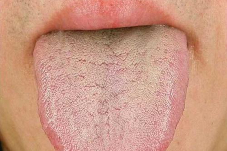 脾胃湿热证舌苔症状图